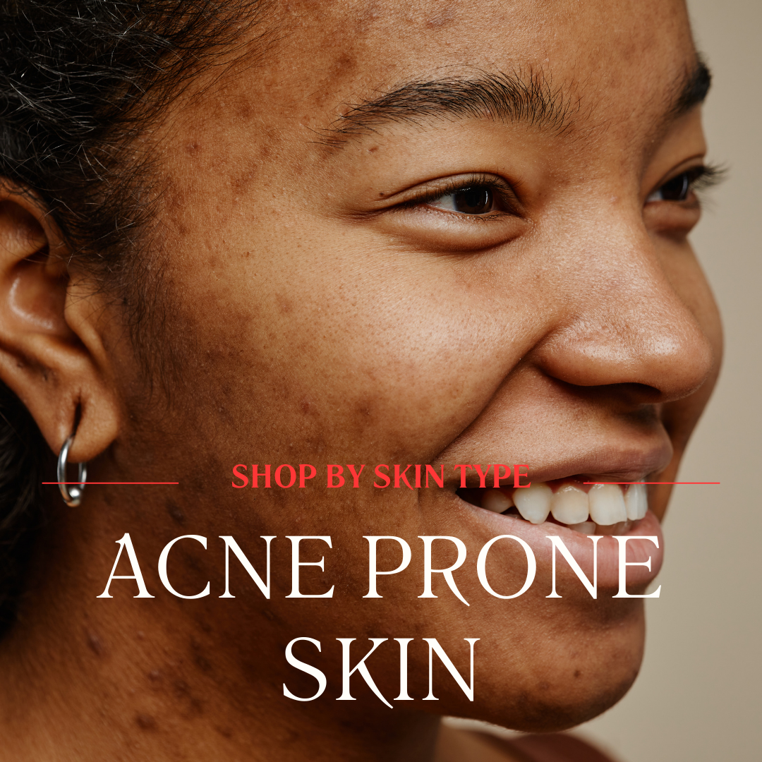 ACNE PRONE SKIN