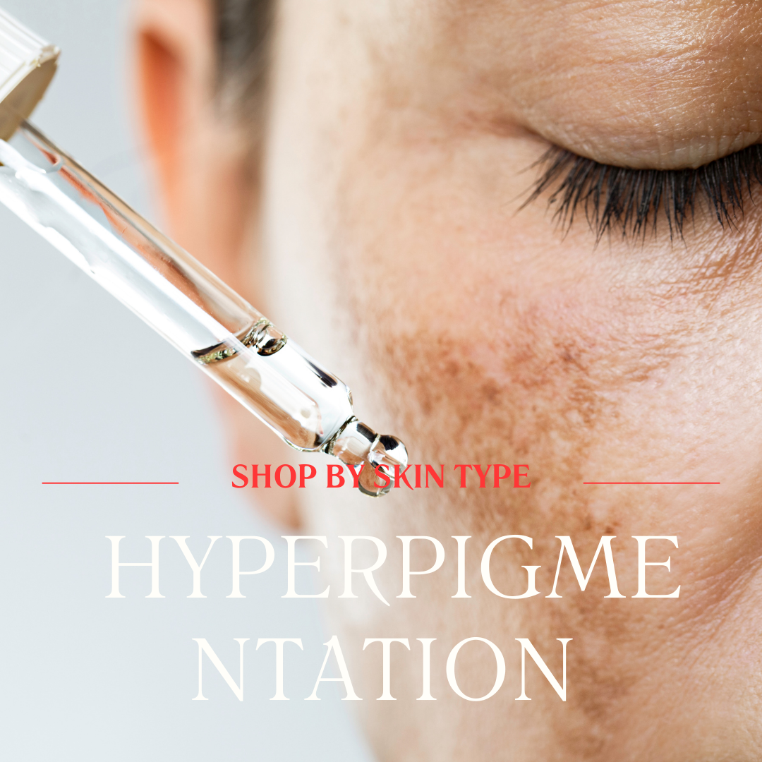 HYPERPIGMENTATION CONCERNS